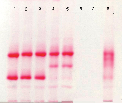 Bio Rad Hemoglobins Portal   Fig 4.30  Pag 70 H Disease And HbS 